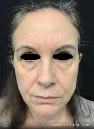 Eyelid Surgery