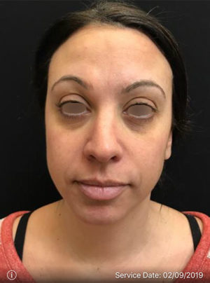 Around The Eye Fillers