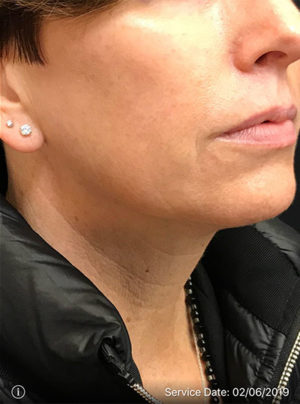 Around The Mouth Fillers