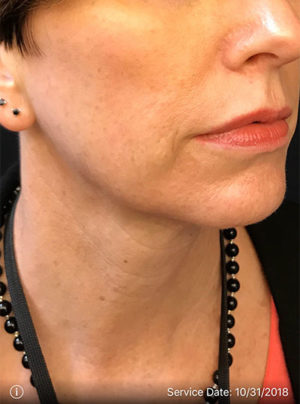 Around The Mouth Fillers