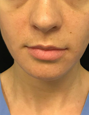 Botox Cosmetic and Dysport