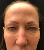 Eyelid Surgery