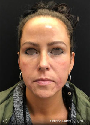 Around The Eye Fillers