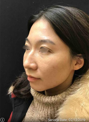 Around The Eye Fillers