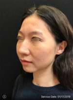Around The Eye Fillers