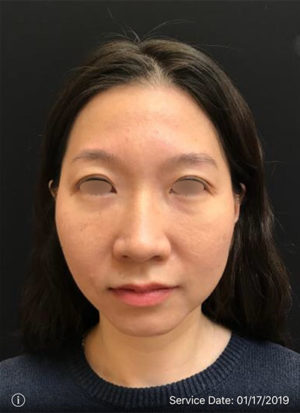 Around The Eye Fillers