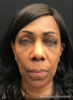Around The Eye Fillers