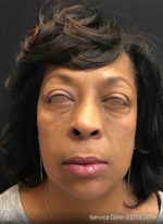 Around The Eye Fillers