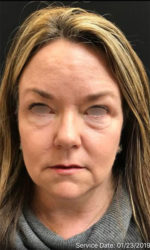 Around The Eye Fillers