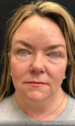 Around The Eye Fillers