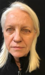 Around The Eye Fillers