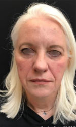 Around The Eye Fillers