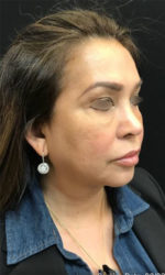Around The Mouth Fillers