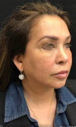 Around The Mouth Fillers