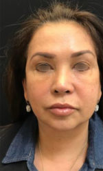 Around The Mouth Fillers