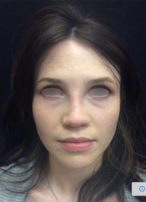 Restylane and Perlane