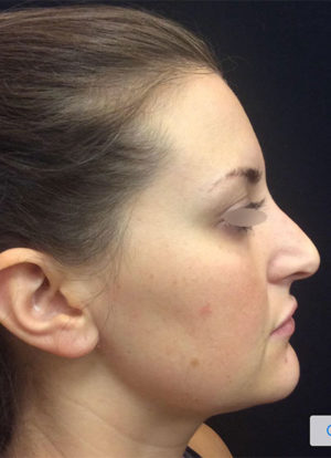 Restylane and Perlane