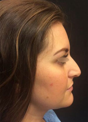 Restylane and Perlane