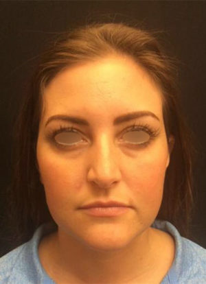 Restylane and Perlane