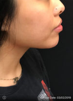 Around The Mouth Fillers