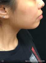 Around The Mouth Fillers