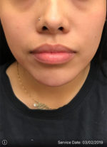 Around The Mouth Fillers