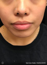 Around The Mouth Fillers