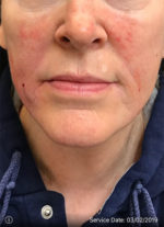 Around The Mouth Fillers