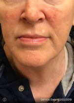 Around The Mouth Fillers