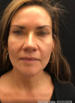 Around The Mouth Fillers