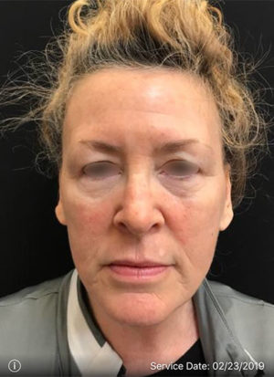 Botox Cosmetic and Dysport