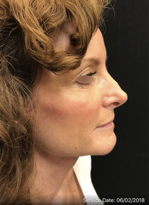 Nose Rejuvenation