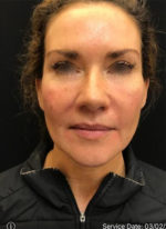 Around The Eye Fillers