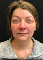Around The Eye Fillers