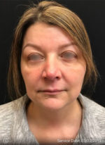 Around The Eye Fillers