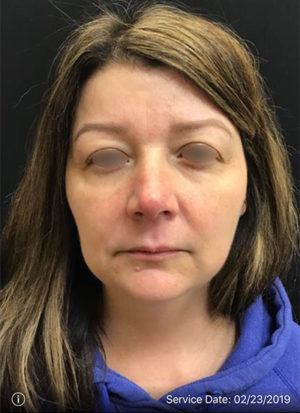 Around The Eye Fillers