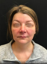 Around The Eye Fillers