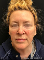 Around The Eye Fillers