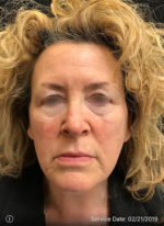 Around The Eye Fillers