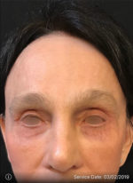 Around The Eye Fillers