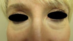 Around The Eye Fillers
