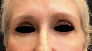 Around The Eye Fillers