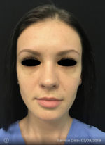 Around The Eye Fillers