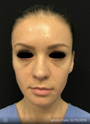 Around The Eye Fillers
