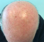 Actinic Keratoses
