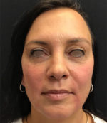 Around The Eye Fillers