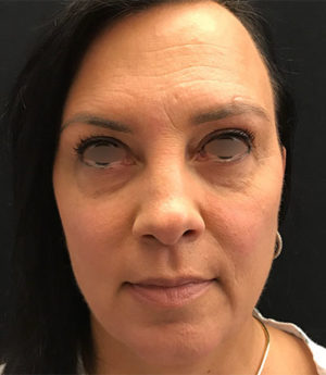 Around The Eye Fillers