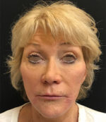 Around The Eye Fillers