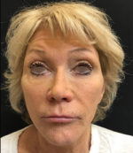 Around The Eye Fillers