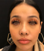 Around The Mouth Fillers